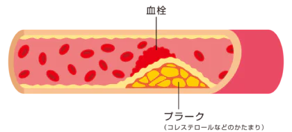 プラーク